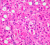 Aufnahmen von krankhaften Leberzellen, Foto: Ed Uthman (CC)